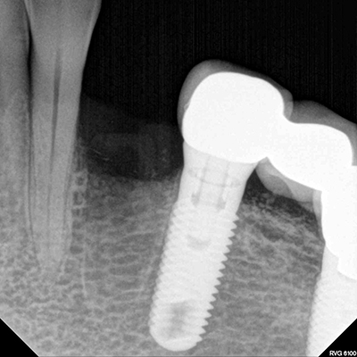 pt1_dental_implants