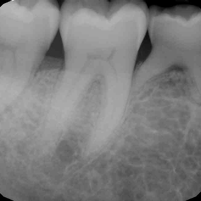 pt1_dental_implants