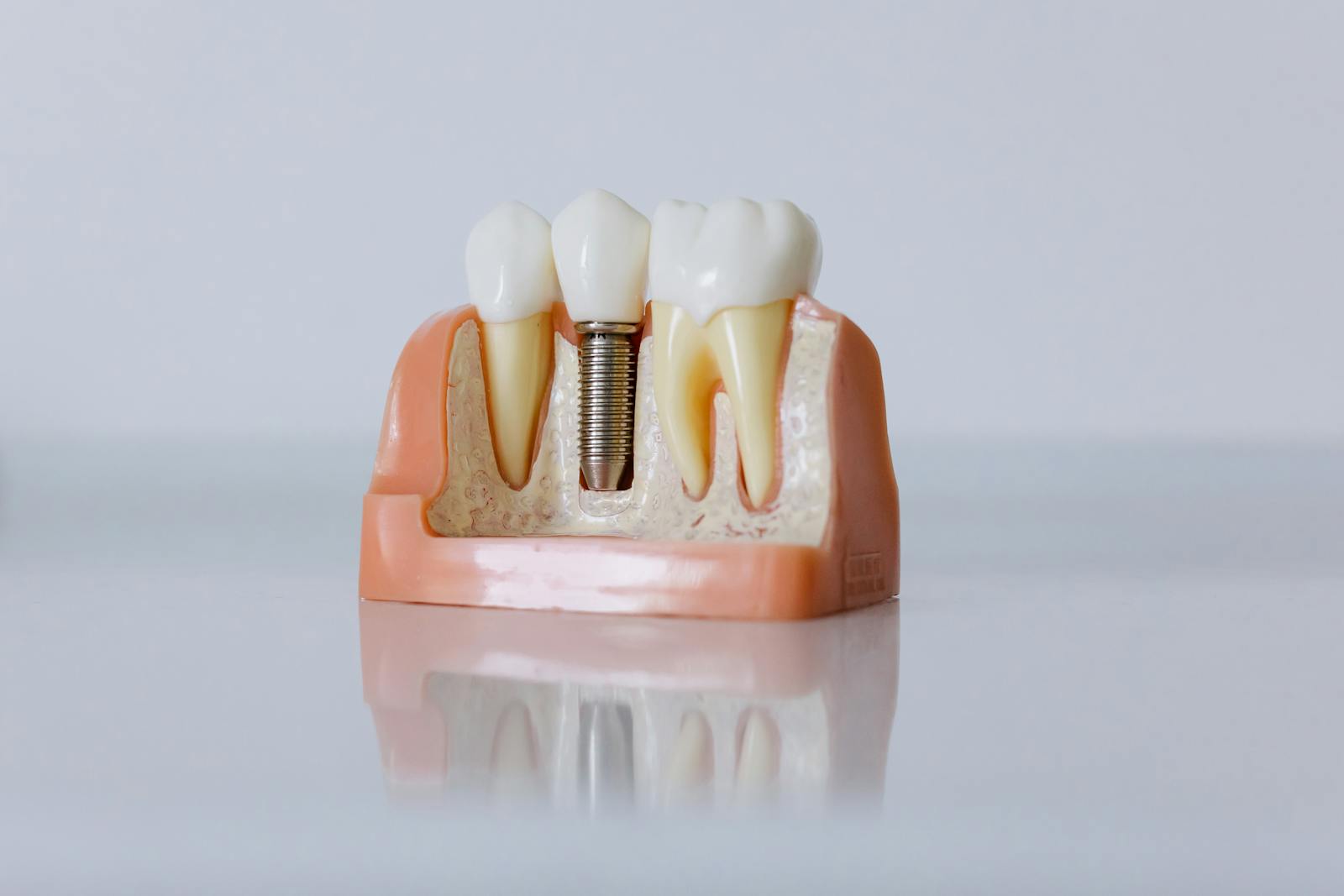 Dental Implants & Bone Health: Why a Strong Jaw Matters